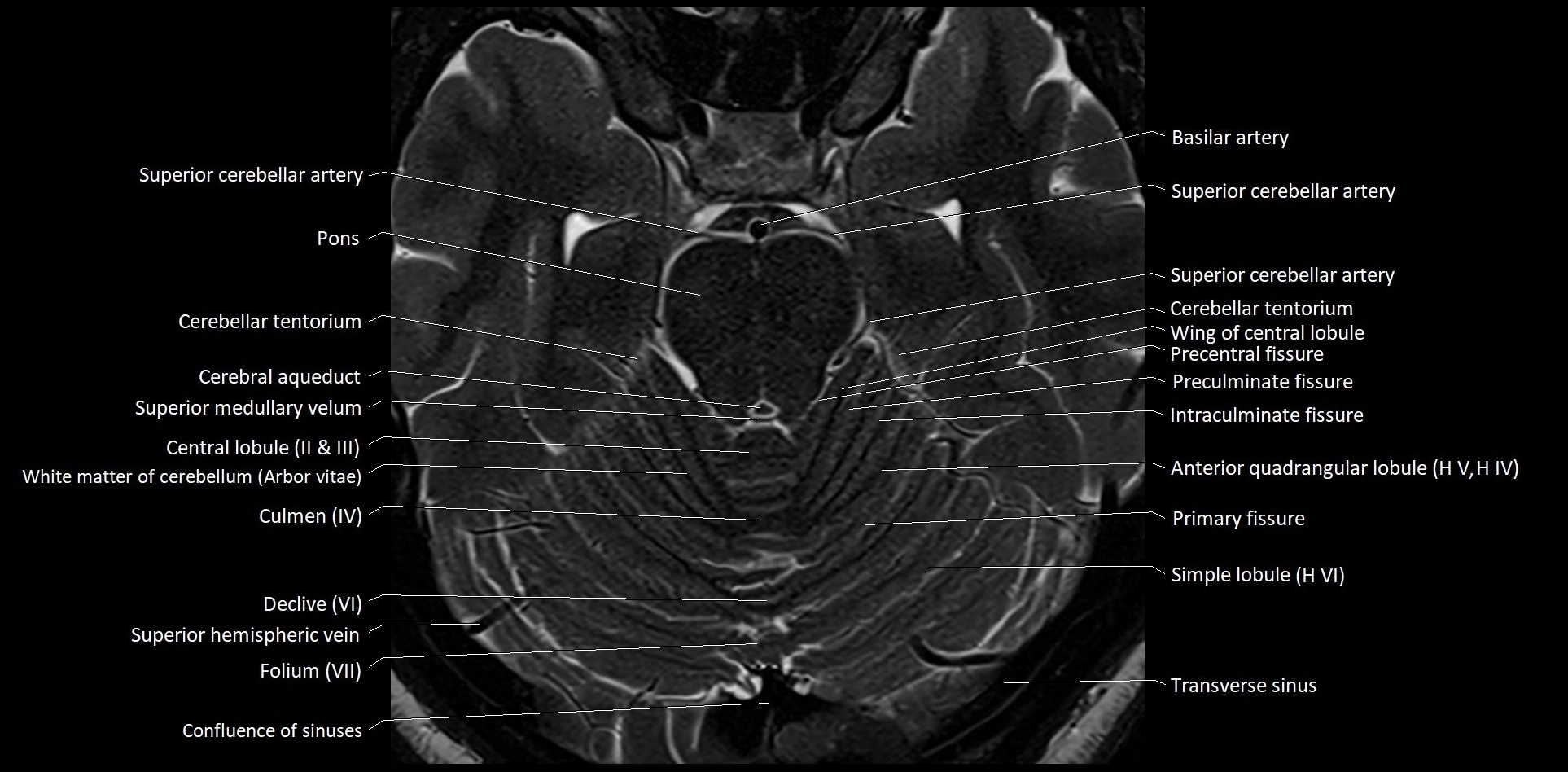 MRI Cerebellar anatomy High-resolution labelled 3T MRI image 20.webp